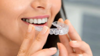 Invisalign