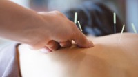 Acupuncture